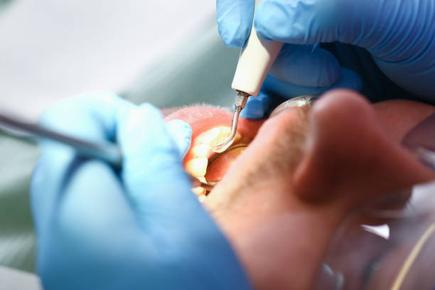 Best Emergency Dentist for Lost Fillings or Crowns in Sugarcreek, PA